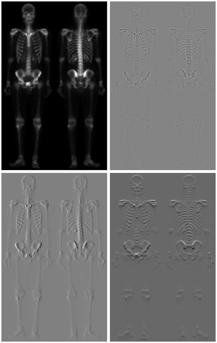 Four panels of a whole-body bone scan showing two skeletons side by side. Top left: the original, bright bones on black. Top right: the Laplacian, a flat light-grey field with a thin speckled outline of the skeleton. Bottom left: Sobel x, mid-grey with the skeleton embossed as if lit from one side, vertical edges strongest. Bottom right: Sobel y, the same embossing but lit from above, horizontal edges strongest. The ribs are far more visible than in the Sobel x panel.